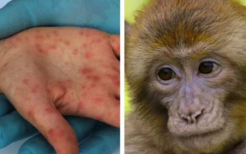 ANSP a pornit o anchetă epidemiologică în baza primului caz de variolă a maimuței înregistrat în Moldova. Care este starea pacientului?