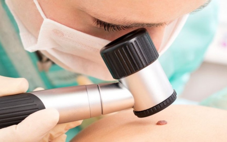 Medic dermatolog: Regulile după care distingem o aluniță periculoasă