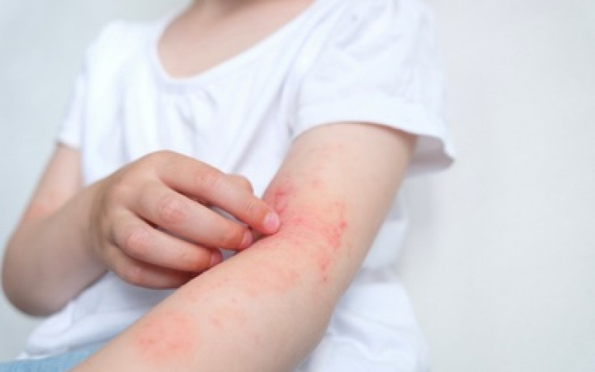 Dermatita atopică: mai mult decât o ”simplă afecțiune a pielii”