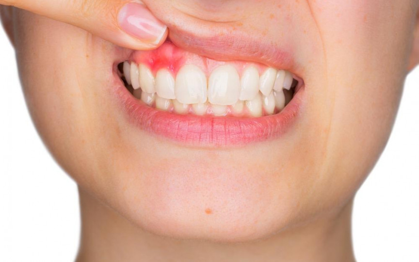 Ce boli grave pot ascunde gingiile vineții, maro, albe sau foarte roșii