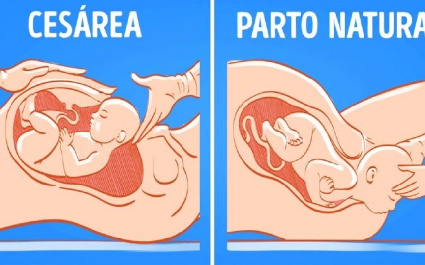 Medic obstetrician-ginecolog despre operația cezariană: Presupune o serie de riscuri atât pentru mamă, cât și pentru făt