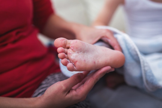 Copilul tău are boala gură-mână-picior? Iată ce ne sfătuiește medicul specialist