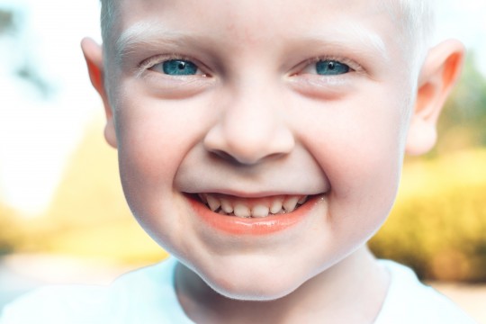 Albinismul, o maladie cu care se poate trăi? Povestea unui copilaș din Moldova