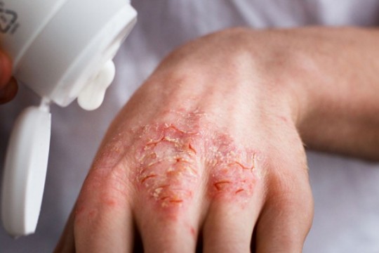 Eczema: cauze, simptome, prevenţie