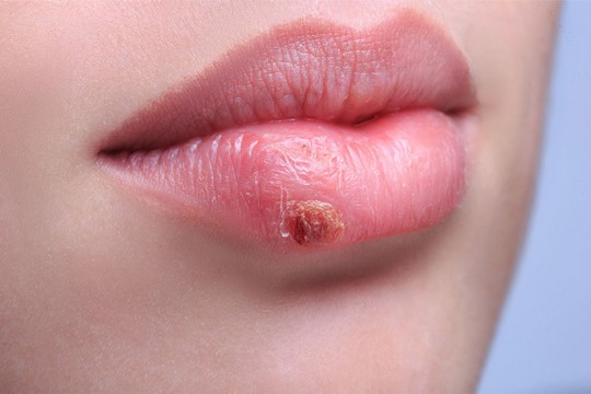 Soluția naturală și rapidă pentru a scăpa ușor de herpesul la buze
