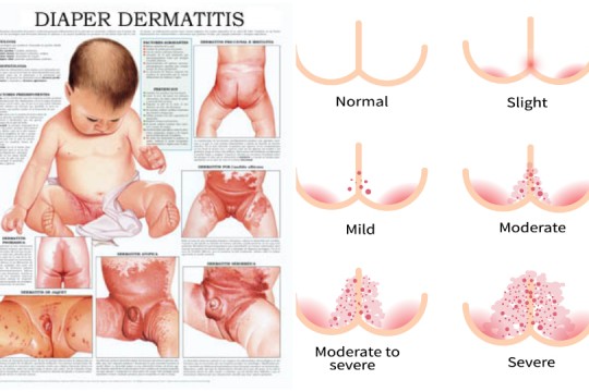Dermatita de scutec, pe înțelesul părinților – sfaturi practice de la medic pediatru