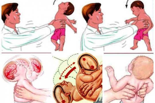 Medic neurolog-pediatru: Zgâlțâitul bebelușului are efecte asemănătoare impactului pe care îl suferă un adult în timpul unui accident de mașină