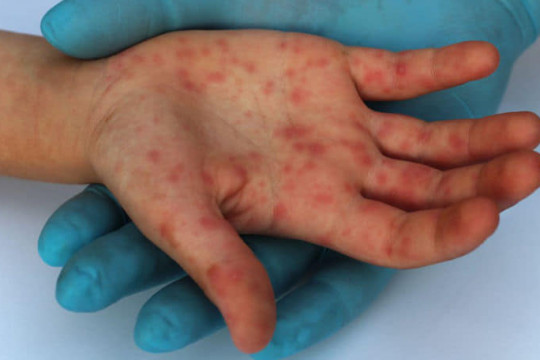 A fost înregistrat primul caz de variola maimuței în Republica Moldova