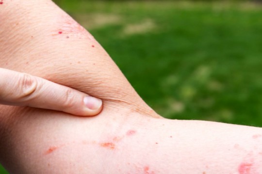 5 remedii pentru iritațiile produse de iedera otrăvitoare