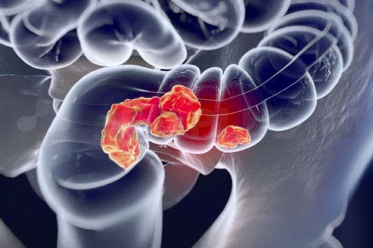 Patru semne principale ale cancerului de colon, dar pe care majoritatea oamenilor le ignoră