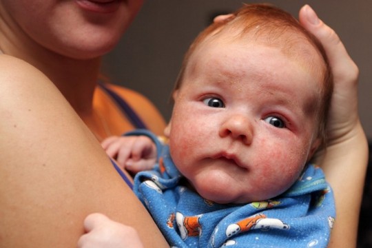 Bolile de piele absolut inofensive la nou-născut