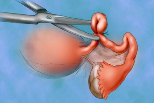 (VIDEO) Legarea trompelor uterine: cum se realizează și ce avantaje și dezavantaje are