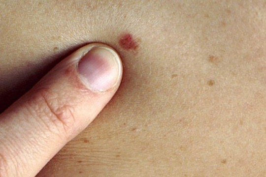 Semnele cancerului de piele, mai ales cele de pe unghiile de la mâini și de la picioare nu ar trebui, sub nicio formă, ignorate