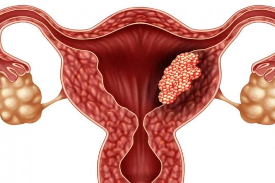 10 mituri demontate despre cancerul de col uterin – ucigașul a peste 300.000 de femei din întreaga lume