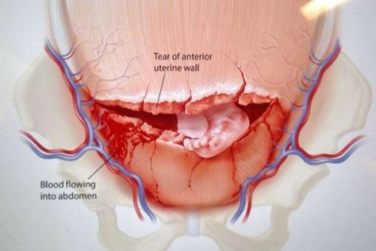 Ruptura uterină – o complicație gravă, care se produce de obicei în timpul travaliului