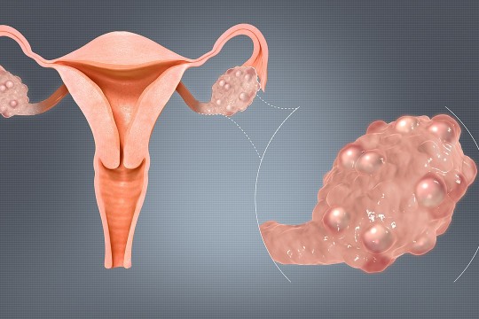 S-a descoperit cauza sindromului ovarului polichistic – o afecțiune care se întâlnește la fiecare a 5-a femeie