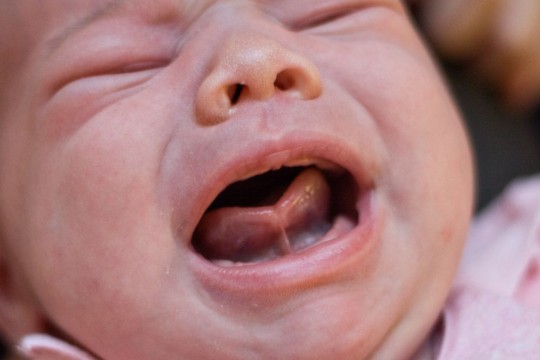 Medic geriatru despre frenul lingual scurt (limba scurtă) la bebeluși: Pot avea dificultăți în timpul hrănirii la sân