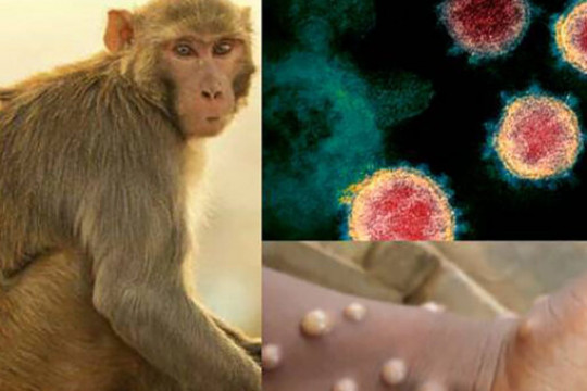 Primul caz de variola maimuței diagnosticat în România