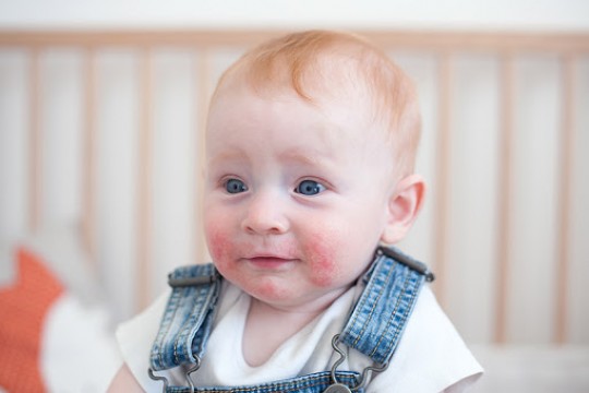 Cum să faci baie copilului dacă are dermatită atopică – sfaturi de la medic dermatolog
