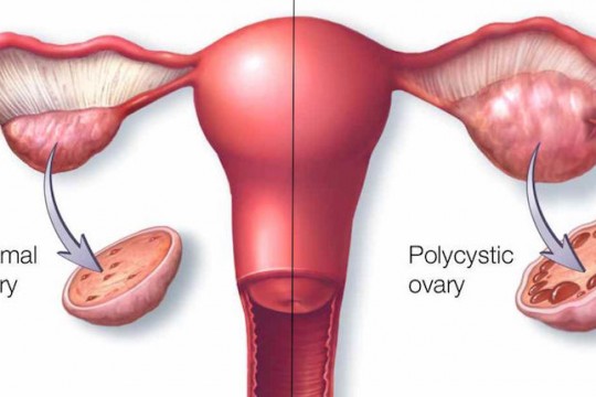 Ginecolog: Sindromul ovarului polichistic nu reduce la zero şansele unei sarcini!