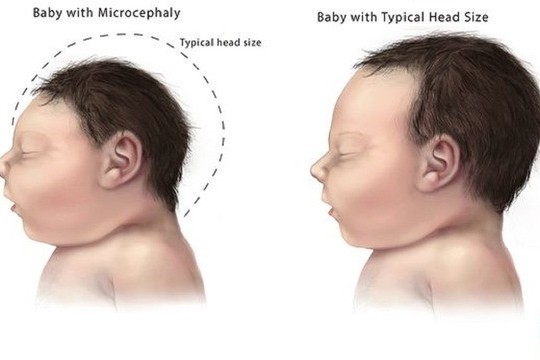 S-a născut primul copil din Europa cu microcefalie cauzată de virusul Zika