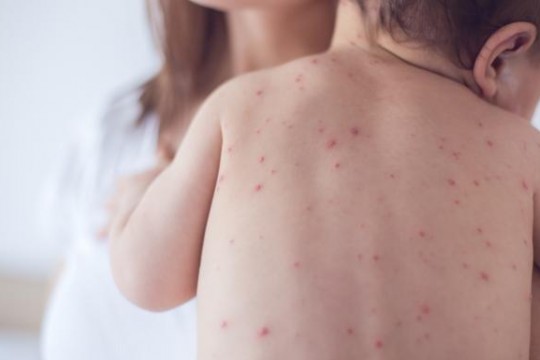 Informații utile de la pediatri despre bolile copilăriei – rujeolă, varicelă, rubeolă, scarlatină