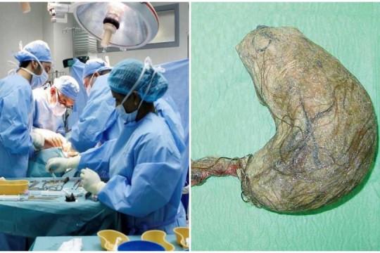 Intervenție chirurgicală neobișnuită: Medicii au înlăturat din stomacul unei adolescente un cheag de păr de 6 kg