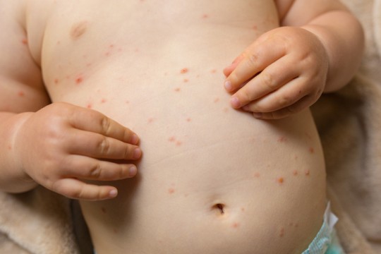 8 mituri despre vaccinare care au provocat epidemii de rujeolă în secolul XXI