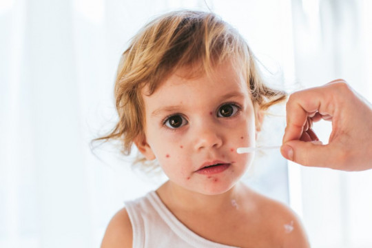 Mihai Craiu: „Petrecerile” cu varicelă reprezintă o formă de abuz împotriva copilului