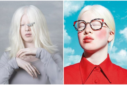 Istoria fetiței care a fost abandonată pentru că s-a născut cu albinism. Acum este un model de succes