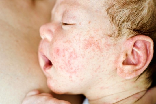 Complicațiile dermatitei atopice la copii și greșelile comise de părinți