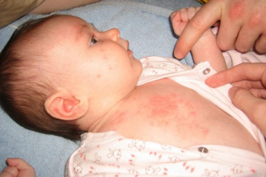 Recunoaște bubițele pe pielea bebelușului provocate de căldură