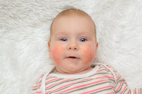 Alergia la laptele de vacă – cel mai frecvent tip de alergie la bebeluși