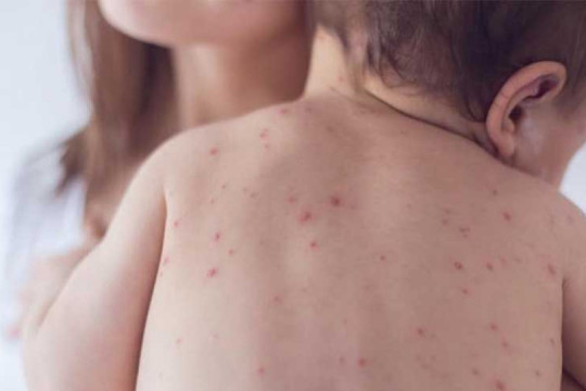 Ce este rozeola la copii și cum o recunoști: simptome, cauze și evoluție