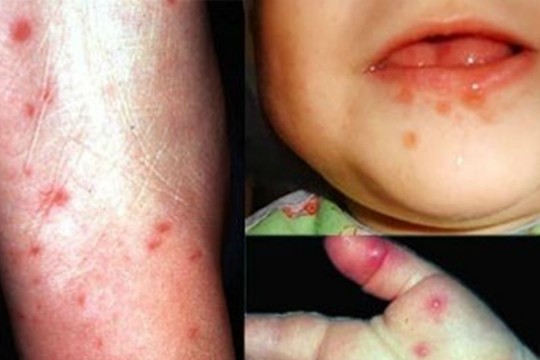 Câțiva moldoveni au contractat în Turcia boala gură-mână-picior. Mai expuși infecției sunt copiii