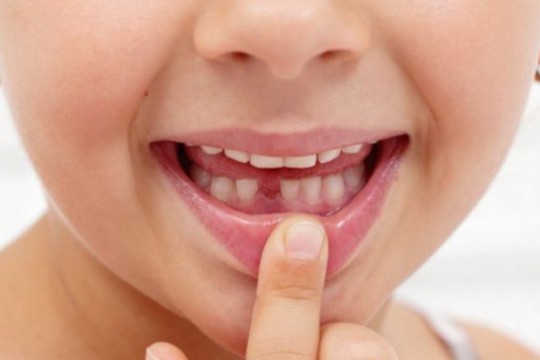 Cât de importantă este sănătatea dinților de lapte și unde greșesc părinții