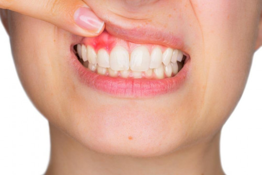 Ce boli grave pot ascunde gingiile vineții, maro, albe sau foarte roșii
