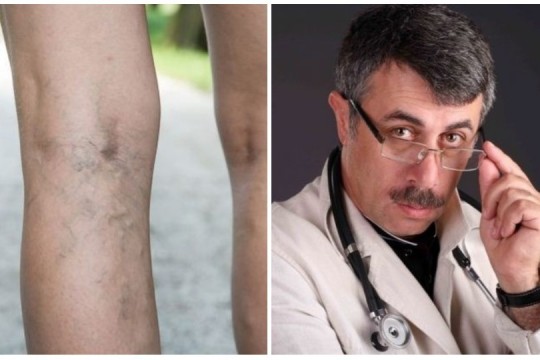 Evghenii Komarovskii are sfaturi și pentru sănătatea mamelor: profilaxia venelor varicoase
