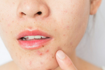 Avertisment medical: Rutinele de skincare promovate pe TikTok pot afecta grav pielea adolescenților