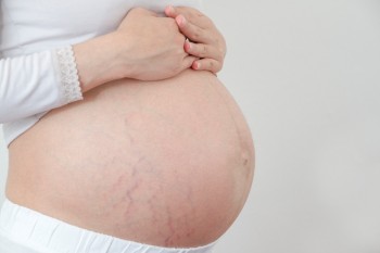 Vergeturile în sarcină: soluții pentru prevenirea și combaterea lor