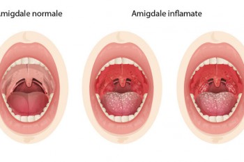 Medic ORL: Un copil nu ar trebui să sufere de amigdalită mai mult de două ori pe an