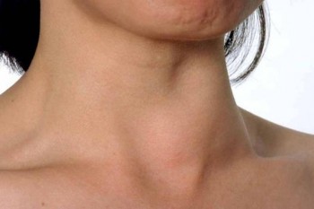 Cel mai evident simptom al lipsei de iod din organism - cauza bolilor de tiroidă