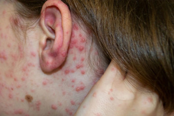 Alertă de rujeolă în Capitală: 5 copii și 3 adulți infectați. Autoritățile cer vaccinare urgentă