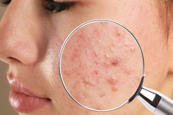 Cum să scapi de petele de acnee. Top 7 remedii naturiste