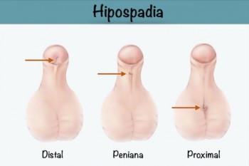 Medic chirurg pediatru despre copilul cu hipospadias și tratamentul chirurgical