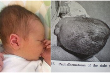 Medic neurolog-pediatru: Cefalhematomul la nou-născut poate apărea în cazul nașterilor dificile