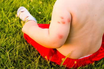 10 cele mai comune alergii la copii, vara