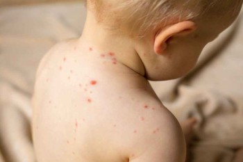 Cod portocaliu de rujeolă în toată țara! Autoritățile planifică vaccinarea tuturor copiilor până la 1 septembrie