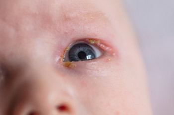 Canal lacrimal înfundat la bebeluși. Ce este de făcut