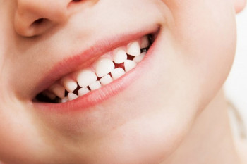 Îngrijirea dinților de lapte: Ce trebuie să știi despre igiena orală la bebeluși și prevenirea cariilor
